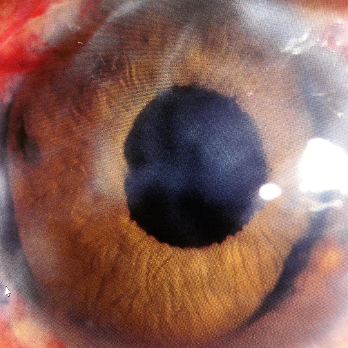 AliMearza's tweet photo. Before and after pics of an eye with extensive traumatic injury and following iris reconstruction and secondary lens implant. #tech #vision #reconstruction #oclvision #artificialiris https://t.co/wN03TMfSqS