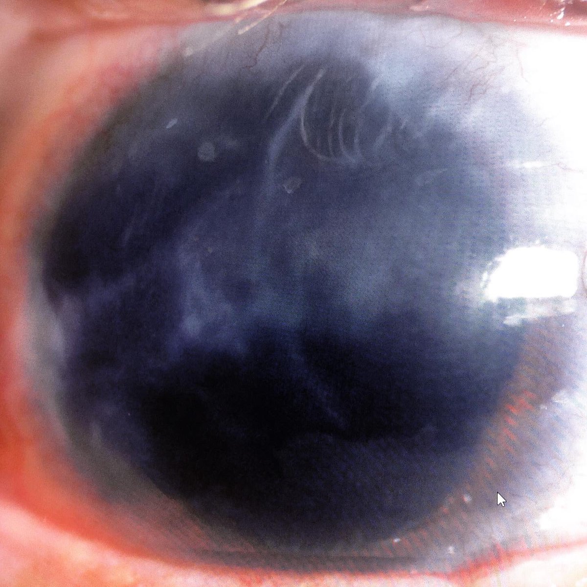 AliMearza's tweet photo. Before and after pics of an eye with extensive traumatic injury and following iris reconstruction and secondary lens implant. #tech #vision #reconstruction #oclvision #artificialiris https://t.co/wN03TMfSqS