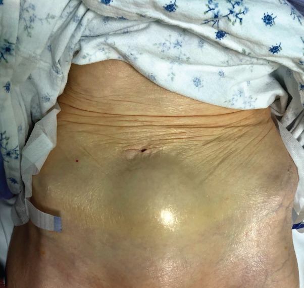 In the BJS/ANA special issue: Snapshot 20/3: A 92‐year‐old woman presented with a non‐tender suprapubic mass that was resonant to percussion. She was otherwise asymptomatic and denied any urinary symptoms. What was the cause of the mass? ow.ly/WWNx30q9ovO