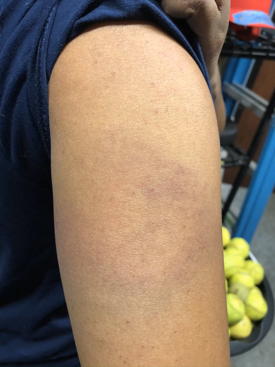 biancaesmith12's tweet image. This is why you get behind the screen when throwing BP. Day 1 and Day 2 😂😂 #shouldknowbetter #notthefirsttime