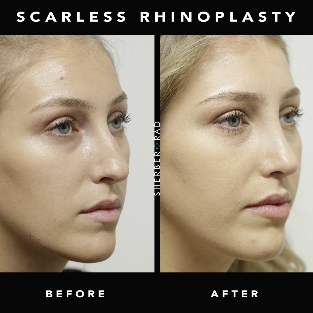 Beautiful rhinoplasty results are achievable with 7 days downtime and ...