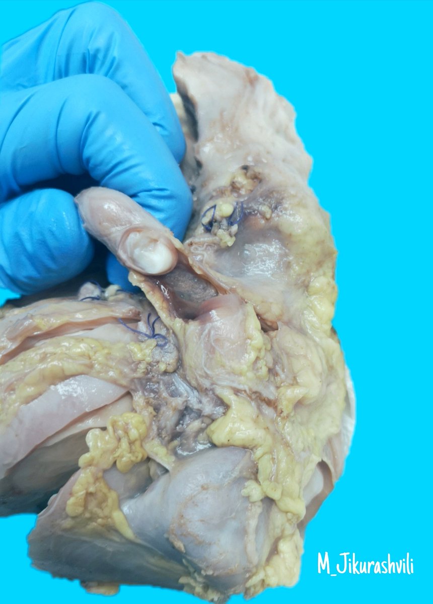 🧑4y old male patient with an encapsulated, non-invasive and mostly homogenous mass in right kidney, compressing the sinus fat and protruding in calyces and ureter.
#grosspath #grossognosis #pathology