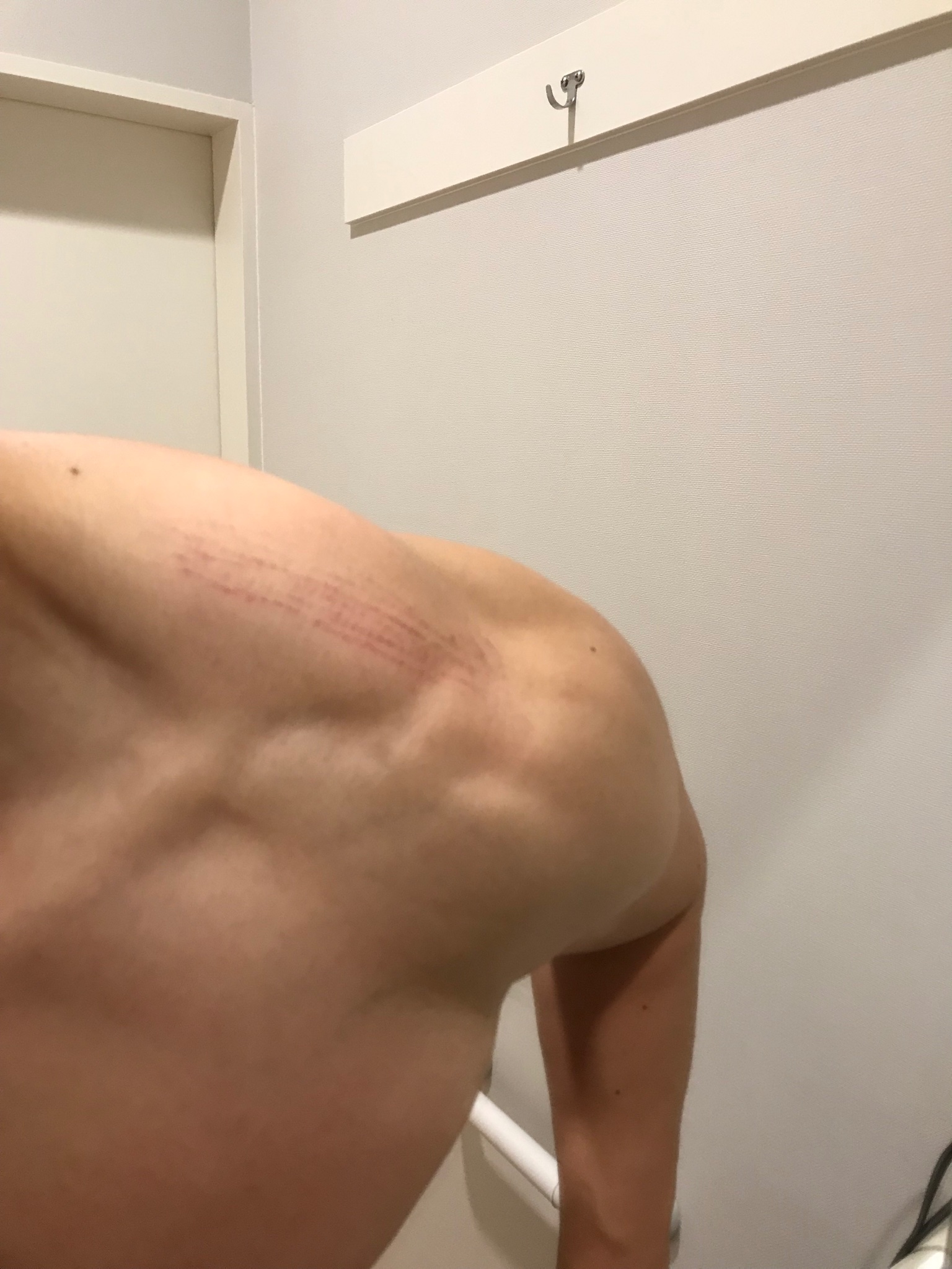 טוויטר Mike בטוויטר 筋トレ後不定期に肩の内出血がでるんだけど おそらくカーフレイズのパットが原因の模様 T Co 0w4kz1k72l