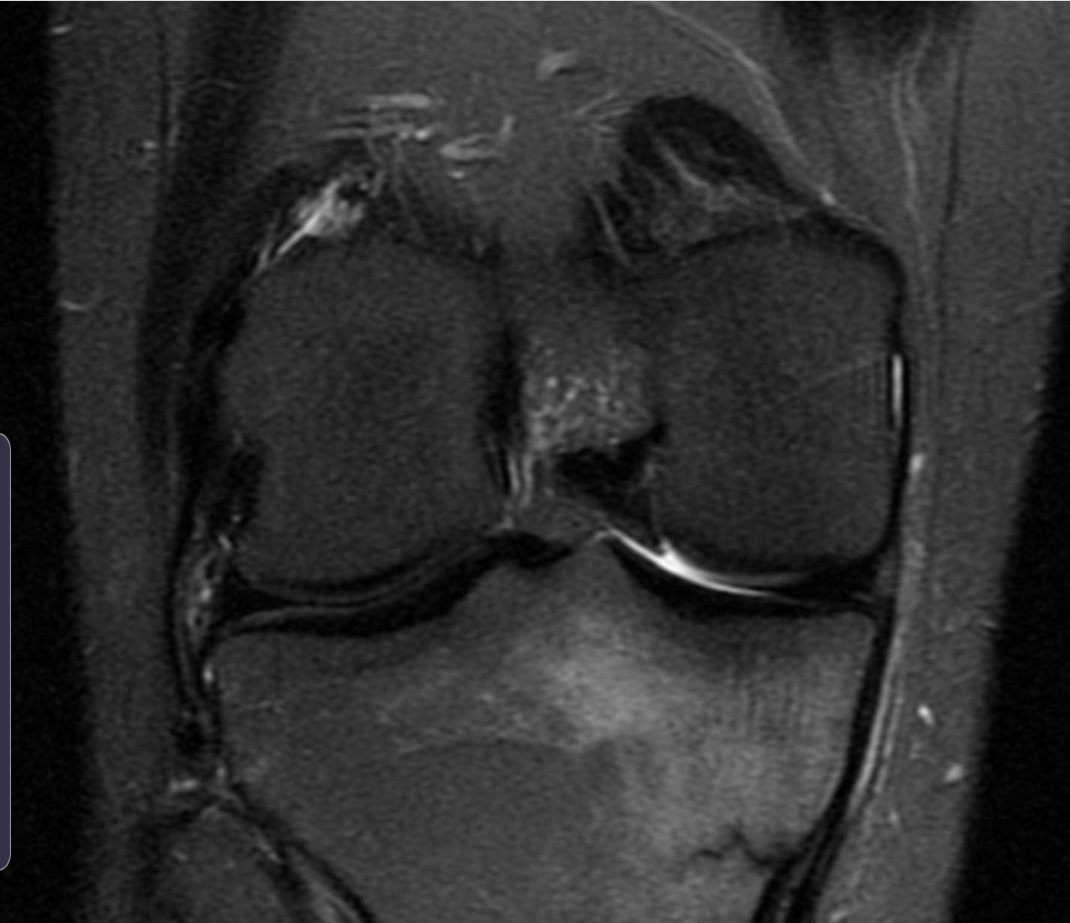 MskSerme's tweet photo. Medial tibia fatigue fracture in a young male runner after running a marathon
#running #stressfracture #runningmarathon #marathon #fatiguefracture #xray #MRI
Look at the entire #CasoDeLaSerme in @Instagram
📸https://t.co/58XqP3B6DL
by @drwillyjara
#MSKRad https://t.co/c2qV1uLqGQ