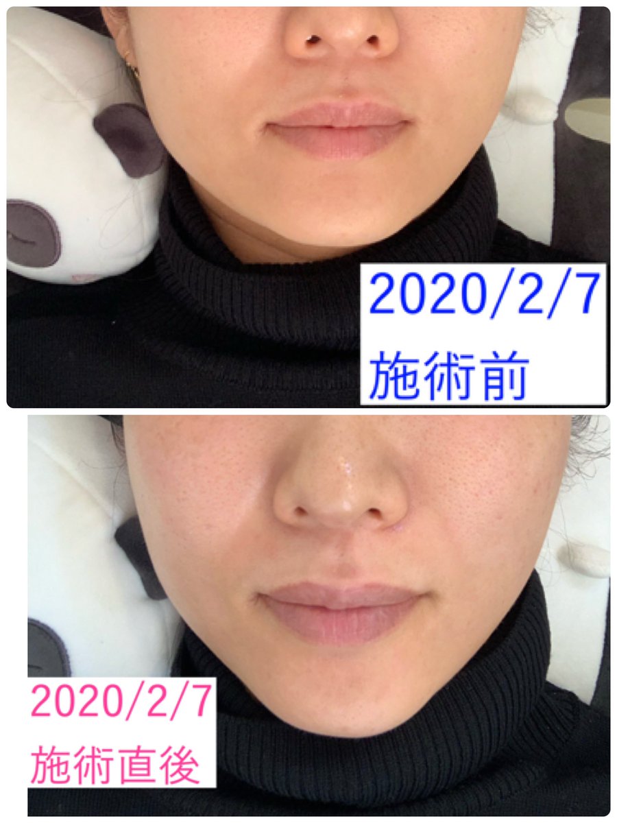 dakarakorea's tweet photo. この即効性!!
百聞は一見にしかずのこの効果♡♡♡
江南の新しい美容外科すごすぎ
#엣지라인클리닉 #edgelineクリニック #エッジラインクリニック #江南 #新沙 #sylfirm #sylfurm効果すごい https://t.co/9D2r4gIAyy