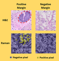 jwtunnell's tweet photo. 1000x is a lot faster... check out the new paper on skin tumor surgical margin detection using superpixels with Raman microscopy by Xu Feng @Xfeng89Xu. @UTBiomedical @CockrellSchool  

https://t.co/njlBeAFYGu https://t.co/Jlb9SoUVME