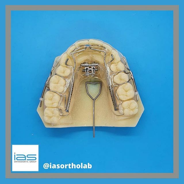Another gorgeous Inman made in the lab this week. Kris produced this beauty on Friday. This one comes with a screw and turning key. 
#Inman #Aligner #orthodontics #ortholab #dentist #IASLab ift.tt/2OCSUSo