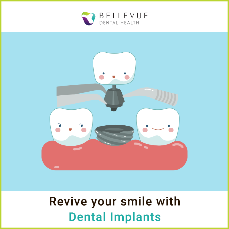 DrLibbiFinnessy's tweet photo. #DentalImplants replace missing teeth &amp; secure loose dentures. We offer a high level of precision in our dental procedures &amp; can guarantee a specialist care for you and your teeth. 
Call (425) 641-3311 to schedule an appointment.
#bellevuedentalhealth #toothacheday https://t.co/zlHc5q6h4C