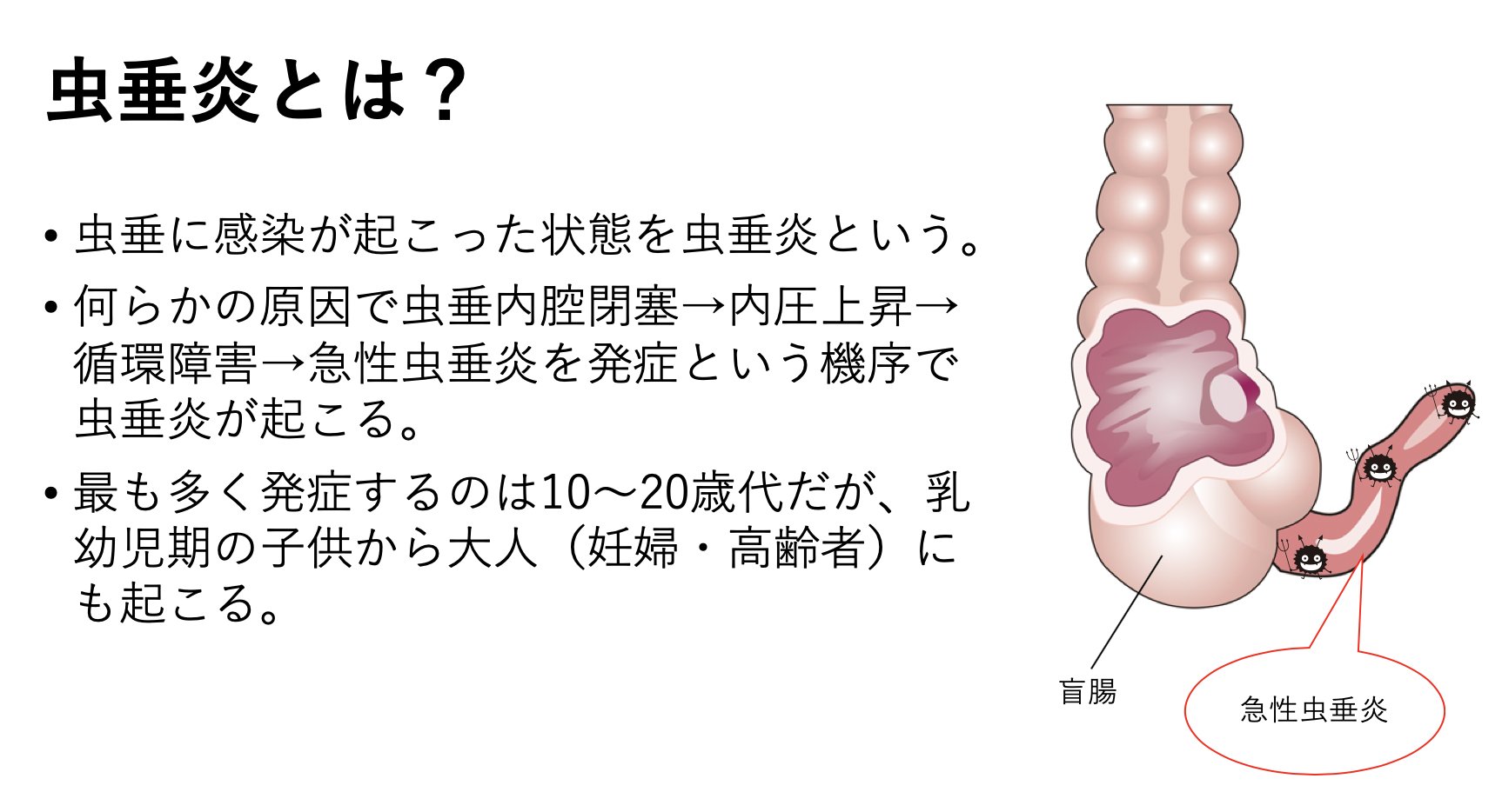 盲腸 虫垂炎 位置