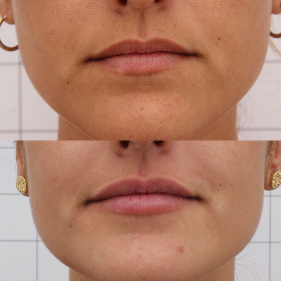 Impresionantes los cambios sutiles y discretos que conseguimos utilizando un producto biocompatible y reabsorvible que aporta #VOLUMEN e #HIDRATACION. Realizamos el tratamiento en varias fases para conseguir un resultado totalmente #natural
#clinicamorano #aumentodelabios #beauty