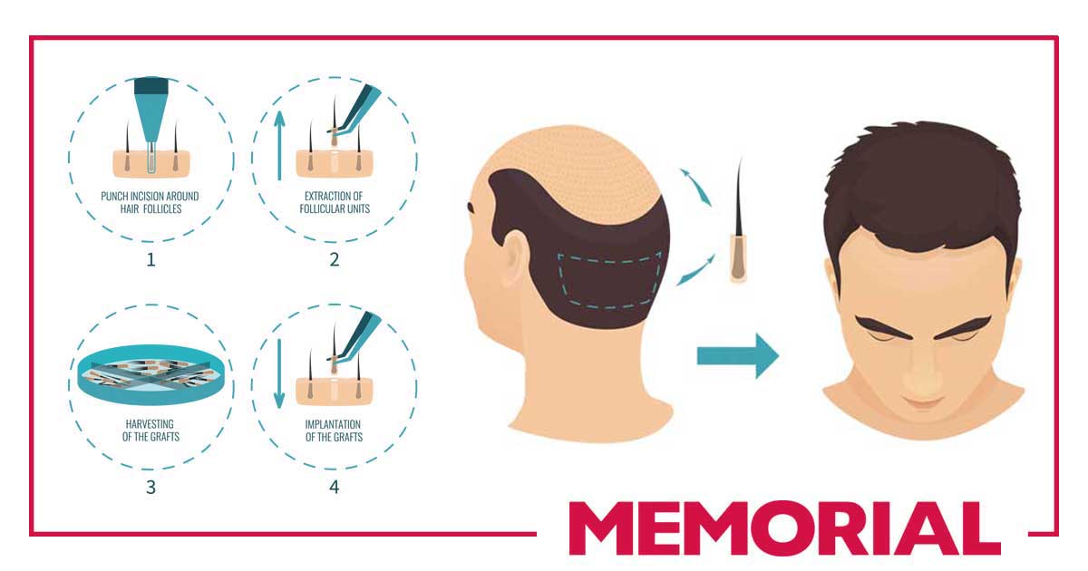 Staffed by our highly experienced doctors, the Memorial Hair Transplantation centers offer all the comfort a full service hospital and the trust of Memorial's 20 years of experience in medicine. For an online consultation, call us at +905496393366

#DHI #hairtransplantation