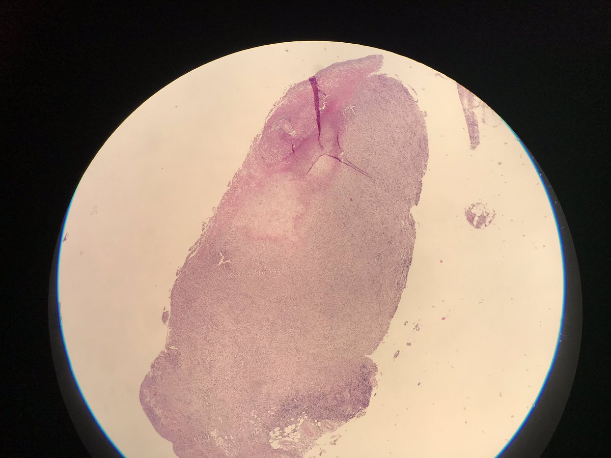 Poullote's tweet image. Any idea ? Exsudative pleural effusion in a farmer. Dense polymorphic infiltrate, many eosinophils, focal necrosis...and an unindentified guest !! Help !! #pathology #infectiousdisease