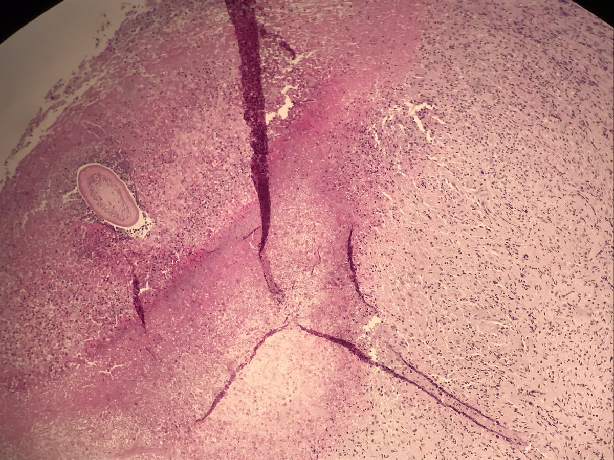 Poullote's tweet image. Any idea ? Exsudative pleural effusion in a farmer. Dense polymorphic infiltrate, many eosinophils, focal necrosis...and an unindentified guest !! Help !! #pathology #infectiousdisease