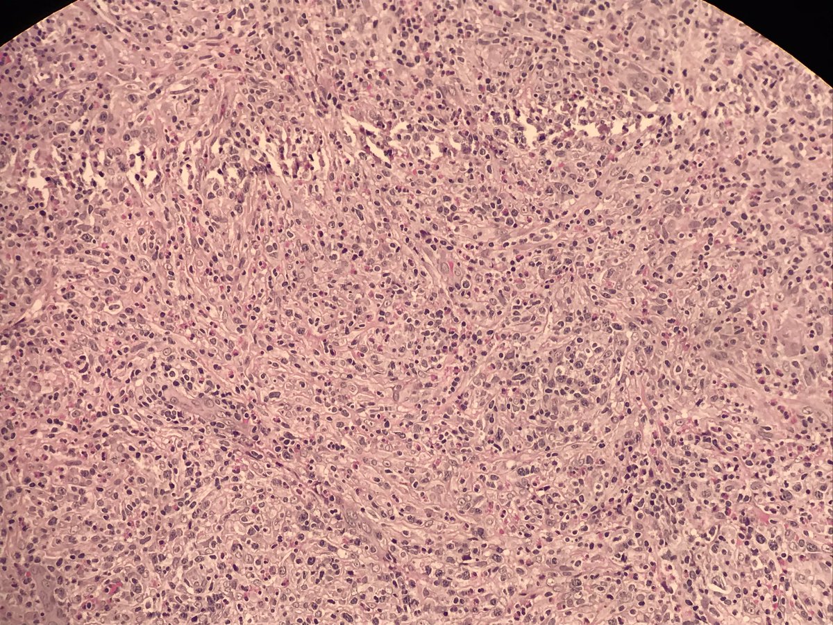 Poullote's tweet image. Any idea ? Exsudative pleural effusion in a farmer. Dense polymorphic infiltrate, many eosinophils, focal necrosis...and an unindentified guest !! Help !! #pathology #infectiousdisease