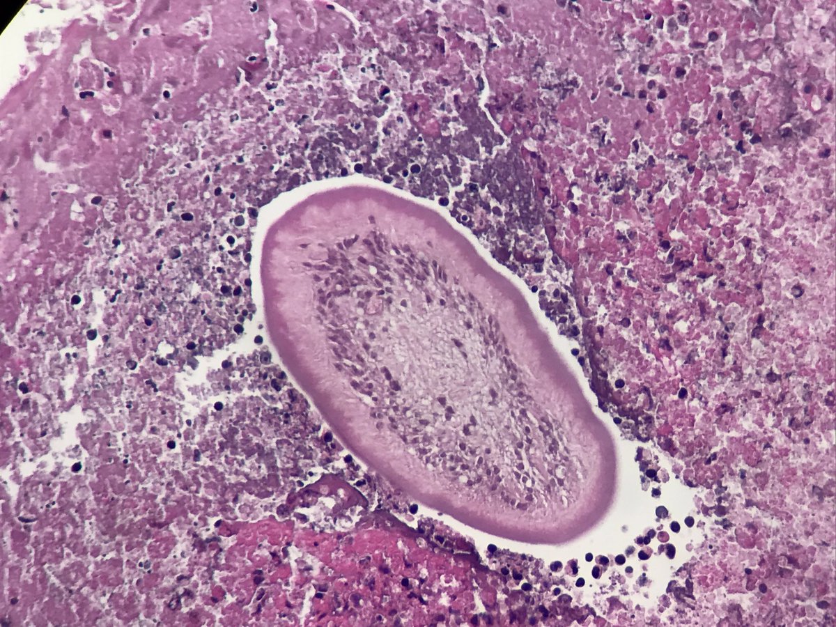 Poullote's tweet image. Any idea ? Exsudative pleural effusion in a farmer. Dense polymorphic infiltrate, many eosinophils, focal necrosis...and an unindentified guest !! Help !! #pathology #infectiousdisease