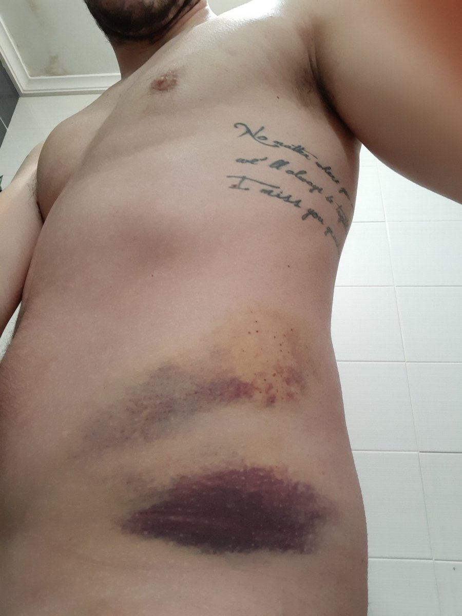 pablocd8's tweet photo. @elchiringuitotv @UDLP_Oficial Hace 3 semanas me paso lo mismo contra un muro.Por suerte solo quedo en un susto. Son un peligro https://t.co/xvFZzqd57Y