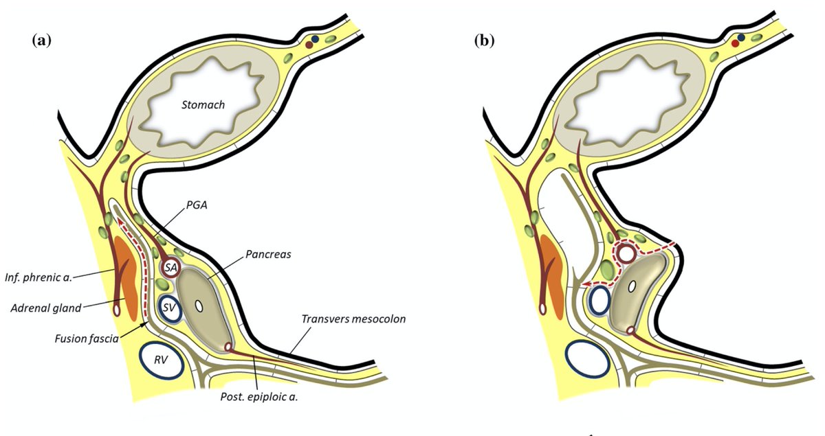 AnnSurgOncol's tweet image. FEBRUARY ISSUE: Laparoscopic Suprapancreatic #LymphNodeDissection Using a Systematic Mesogastric Excision Concept for #GastricCancer. ow.ly/5pj850yhK94 @McMastersKelly @SocSurgOnc