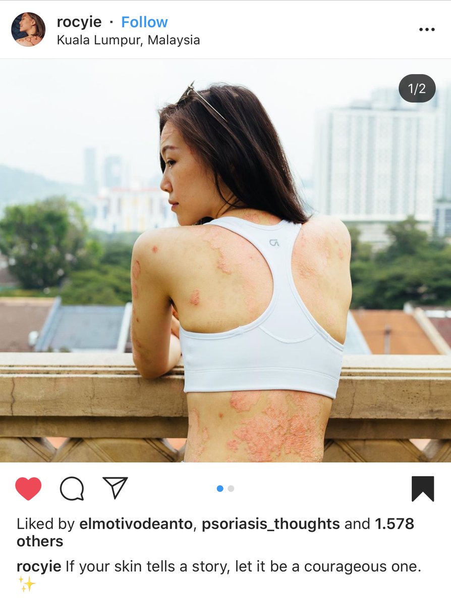 accionpsoriasis's tweet photo. #PsoriasisWorldWide 🌍

👉 Hoy destacamos a Rocyie compartiendo su lucha con la #psoriasis desde Malaysia. En su cuenta de instagram nos dice: "Si tu piel cuenta una historia, que sea una con coraje" 

¡GRACIAS POR NORMALIZAR! 📢💪 https://t.co/7AhcDeI7cb
