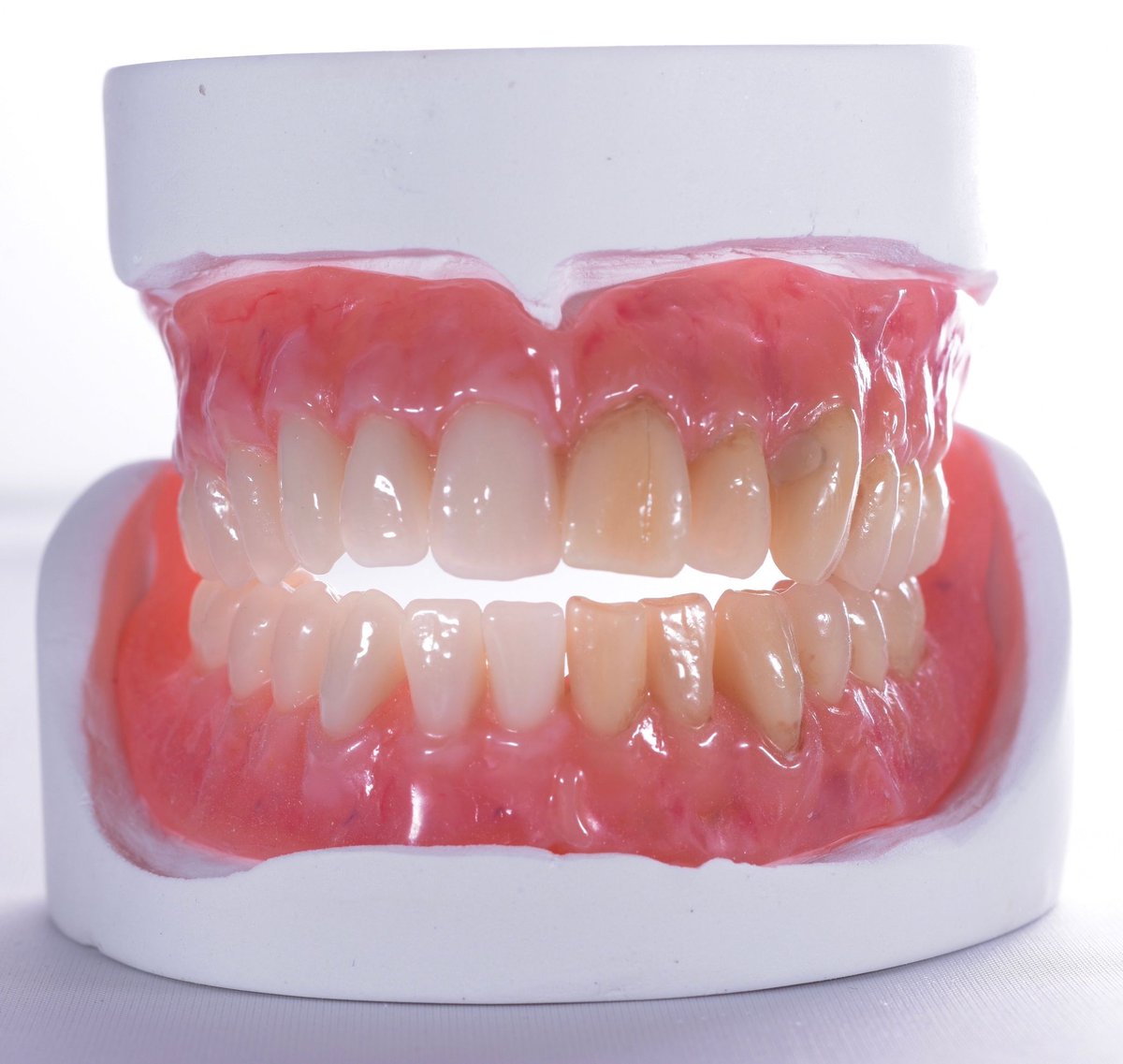 Queenswaylab's tweet photo. 🔶Some amazing characterisation of some F/F dentures from our prosthodontic department.🔶
🔷Makes these prosthetics more personal and unique to the patient.🔷
🔶Colours and texture brought to life using crea.lign by @BredentUK.🔶 https://t.co/ccsxcbEzPO