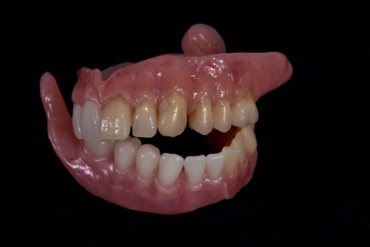 Queenswaylab's tweet photo. 🔶Some amazing characterisation of some F/F dentures from our prosthodontic department.🔶
🔷Makes these prosthetics more personal and unique to the patient.🔷
🔶Colours and texture brought to life using crea.lign by @BredentUK.🔶 https://t.co/ccsxcbEzPO