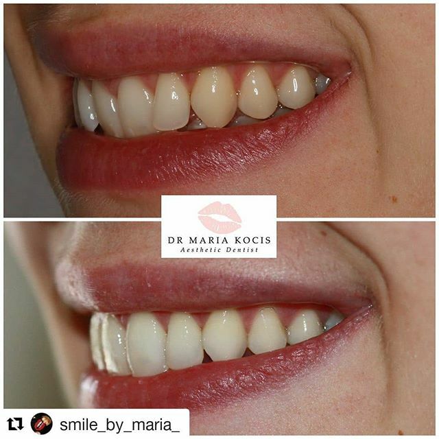 Brilliant results by @smile_by_maria_ 👏 looking fantastic! 
#Repost @smile_by_maria_ (<a href="/get_repost/">Repost</a>)
・・・
Smile makeover with clear aligners <a href="/iasortholab/">IAS Laboratory</a>  @iasortho and composite bonding . No drilling, no injections.

#dentistry #dental #dentist #dental… ift.tt/2OFil5O