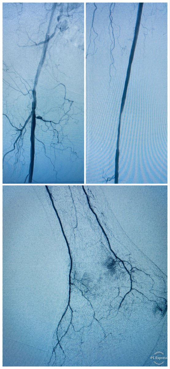 Carlos Guevara MD, FSIR (@carlosguevarair) on Twitter photo #CLIFighters chronic SFA stent CTO, <a href="/K_Langy/">Kris L</a> recan cath/wire, stenosis despite 5,6,7mm high press balloon, improved w stacked supera and plasty (heel, dorsum chronic wound), advice if laser n/a? <a href="/ZagumBhatti/">Zagum Bhatti MD</a> @Saukalaka <a href="/WashUIR/">Mallinckrodt IR</a> <a href="/LessneVIR/">Mark Lessne, MD</a> <a href="/SDhandMD/">Sabeen Dhand</a> <a href="/saherssabri/">Saher Sabri</a> <a href="/VISLAMDSCAIP/">GVATAKEN</a> #CLIFighters chronic SFA stent CTO, <a href="/K_Langy/">Kris L</a> recan cath/wire, stenosis despite 5,6,7mm high press balloon, improved w stacked supera and plasty (heel, dorsum chronic wound), advice if laser n/a? <a href="/ZagumBhatti/">Zagum Bhatti MD</a> @Saukalaka <a href="/WashUIR/">Mallinckrodt IR</a> <a href="/LessneVIR/">Mark Lessne, MD</a> <a href="/SDhandMD/">Sabeen Dhand</a> <a href="/saherssabri/">Saher Sabri</a> <a href="/VISLAMDSCAIP/">GVATAKEN</a>