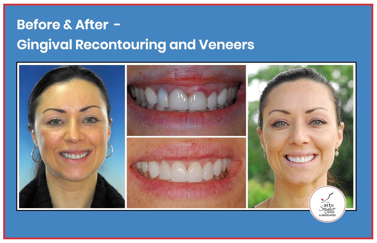 bethsnyderdmd's tweet image. Are you hiding behind an unhealthy smile? It's more common than you think because patients are unsure of where to start.

Dr. Beth Snyder is here to help by combining functionality and aesthetics to create a healthier smile. Call today! BethSnyderDMD.com #SmileExpert