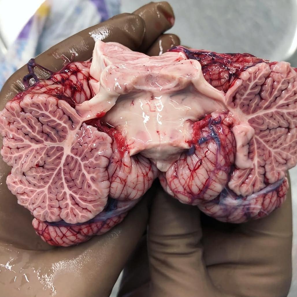 anatomiae_'s tweet image. O cerebelo é uma coisa linda, né?! 😍🧠
📸 @ 123anatomy_human321