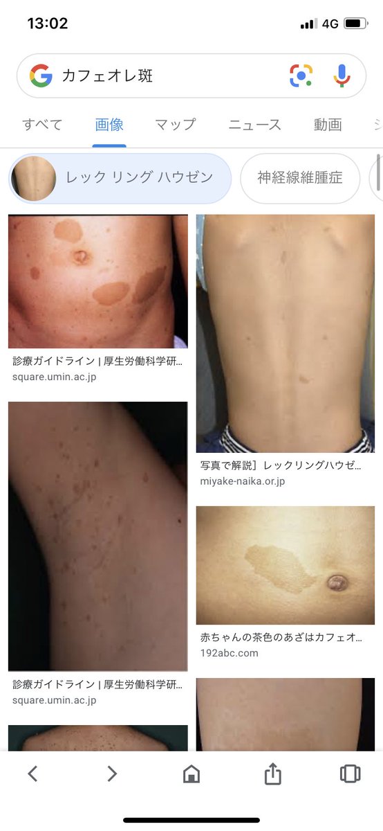 流星 マスク 製油所 レック リング ハウゼン 病 赤ちゃん 脱臼する 金属 モーション