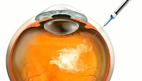 Ophtalmo's tweet photo. 👁️ Diminuer la douleur lors des injections intravitréennes en tenant la main du patient
👁‍🗨 https://t.co/hqWJCFFyxS
#IVT https://t.co/ncflfWSqkl