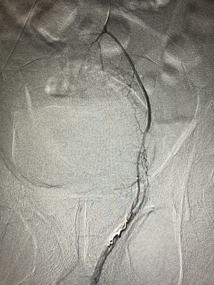 pparmetIR's tweet photo. Life-threatening hematochezia localized by CTA to low rectum, successfully embolized by #IRad (superior rectal artery) #withoutascalpel.  But be mindful of dual rectal arterial supply from both IMA and bilat IIAs. @SIRRFS @SIRspecialists @SIR_ECS https://t.co/3qPtnmUV9b