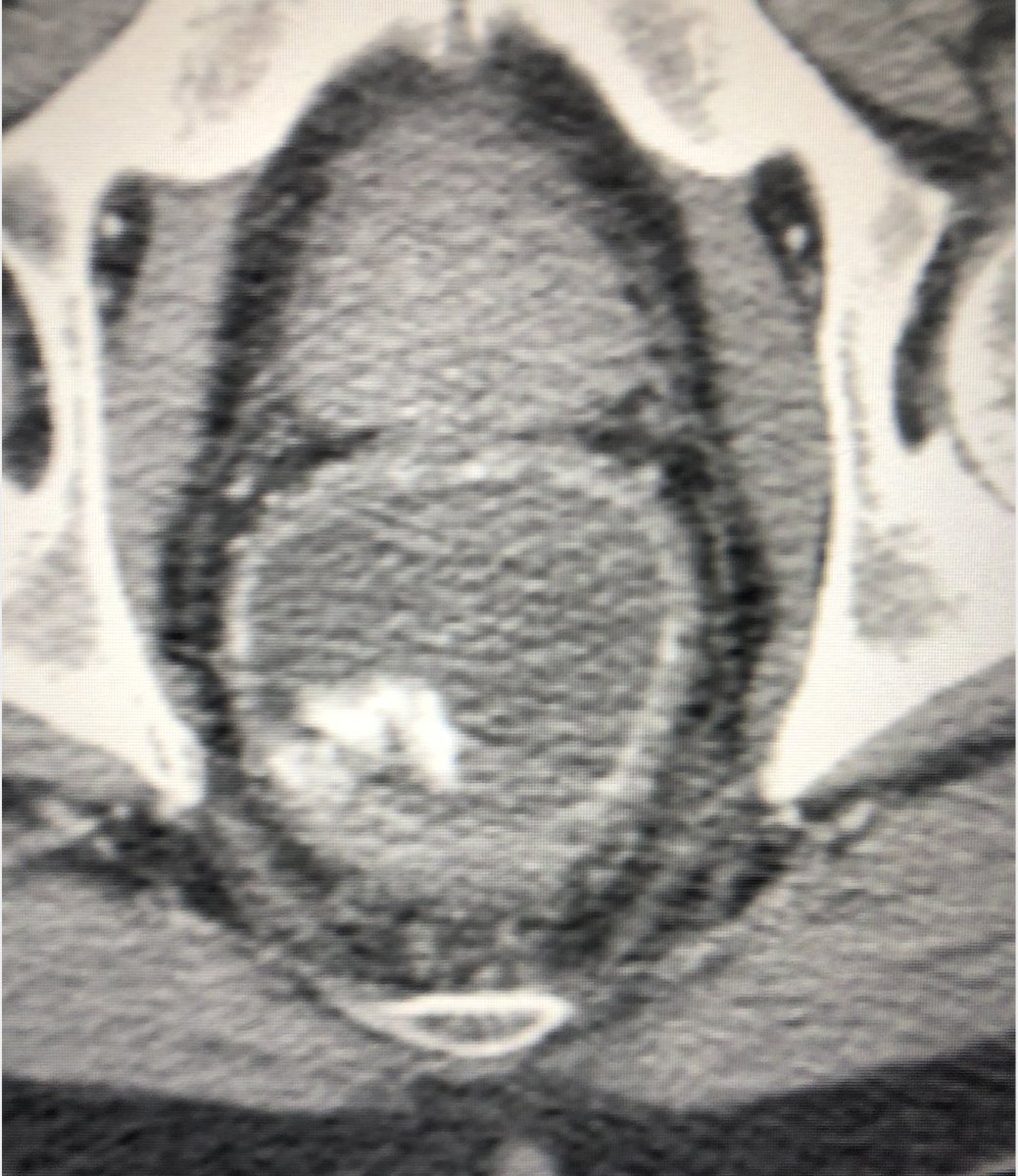 pparmetIR's tweet photo. Life-threatening hematochezia localized by CTA to low rectum, successfully embolized by #IRad (superior rectal artery) #withoutascalpel.  But be mindful of dual rectal arterial supply from both IMA and bilat IIAs. @SIRRFS @SIRspecialists @SIR_ECS https://t.co/3qPtnmUV9b