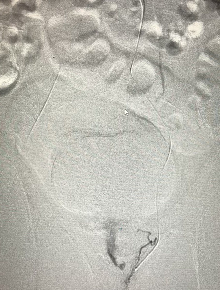 pparmetIR's tweet photo. Life-threatening hematochezia localized by CTA to low rectum, successfully embolized by #IRad (superior rectal artery) #withoutascalpel.  But be mindful of dual rectal arterial supply from both IMA and bilat IIAs. @SIRRFS @SIRspecialists @SIR_ECS https://t.co/3qPtnmUV9b