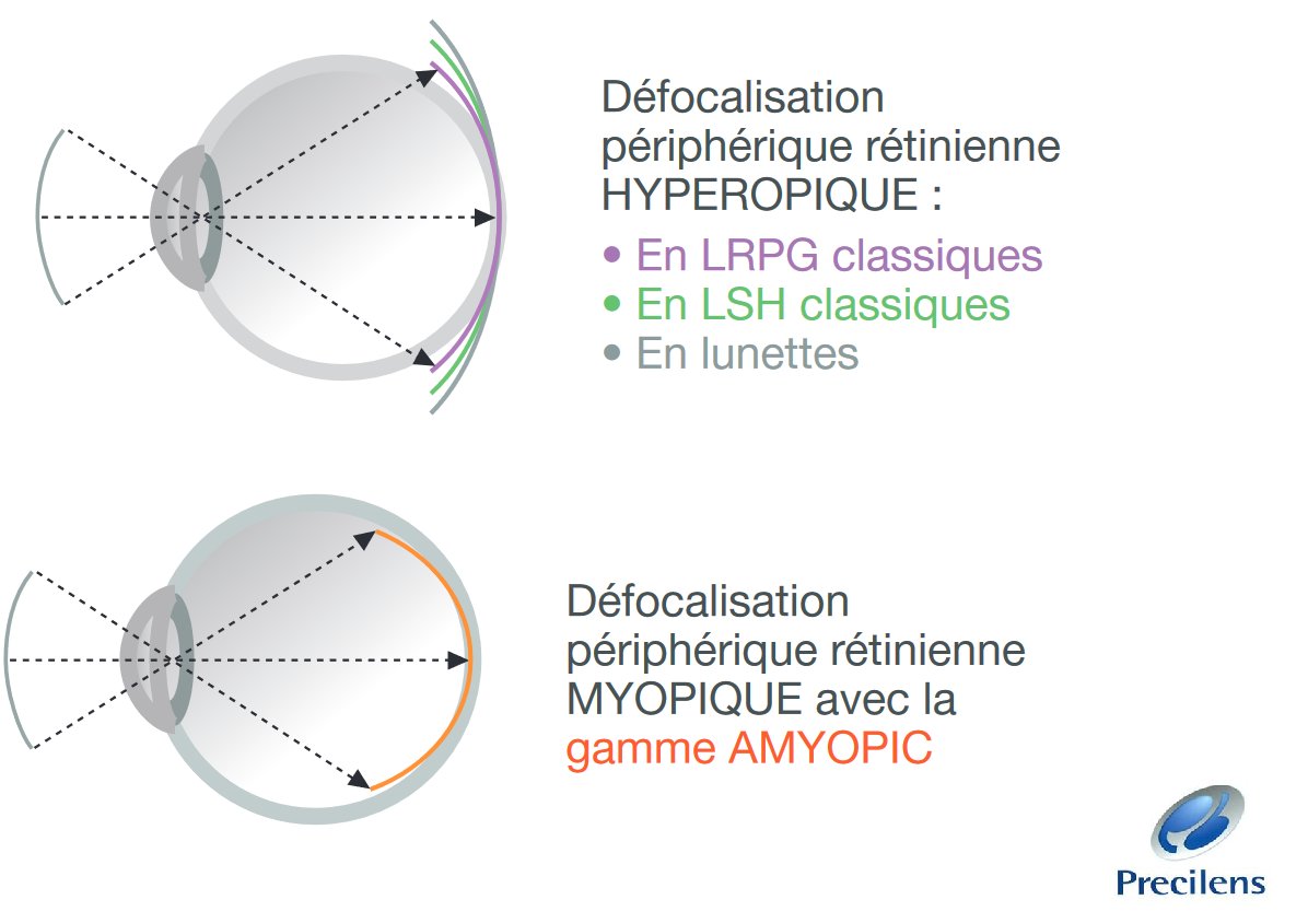 LPrecilens's tweet photo. Contrôler l'évolution de la #myopie des #enfants astigmates en port diurne : découvrez notre gamme AMYOPIC toric en version rigide et souple ! https://t.co/Rho7e2TAgL https://t.co/EJ3B57TNFs