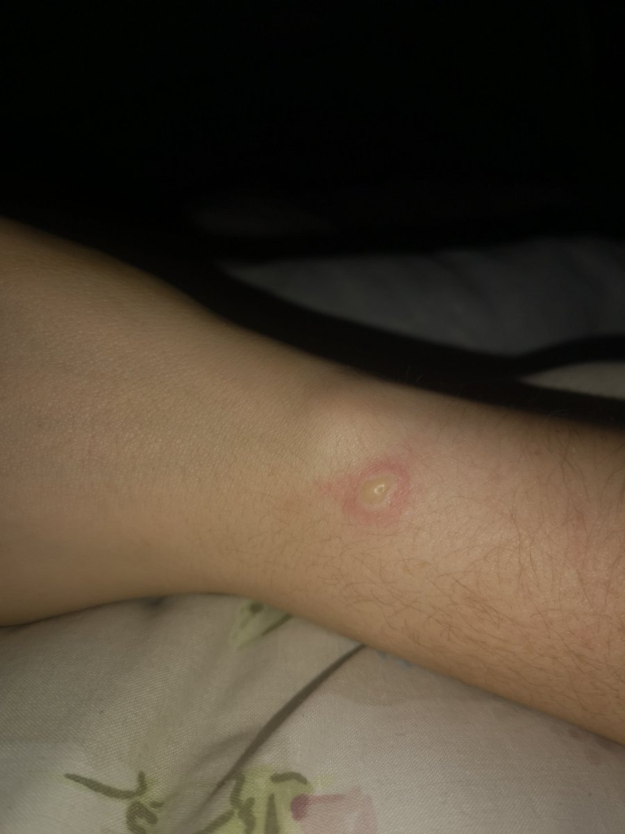 anthearosejane's tweet photo. Had my @FitbitUK Blaze since Christmas 2017, it's been an absolute dream, until the past 2 weeks.  
Dying after half a day (usually last a few days?), and I wake up this morning to find I've evidently knocked it off due to this??  OUCH! 😰😱 https://t.co/l1YyxsmBVq