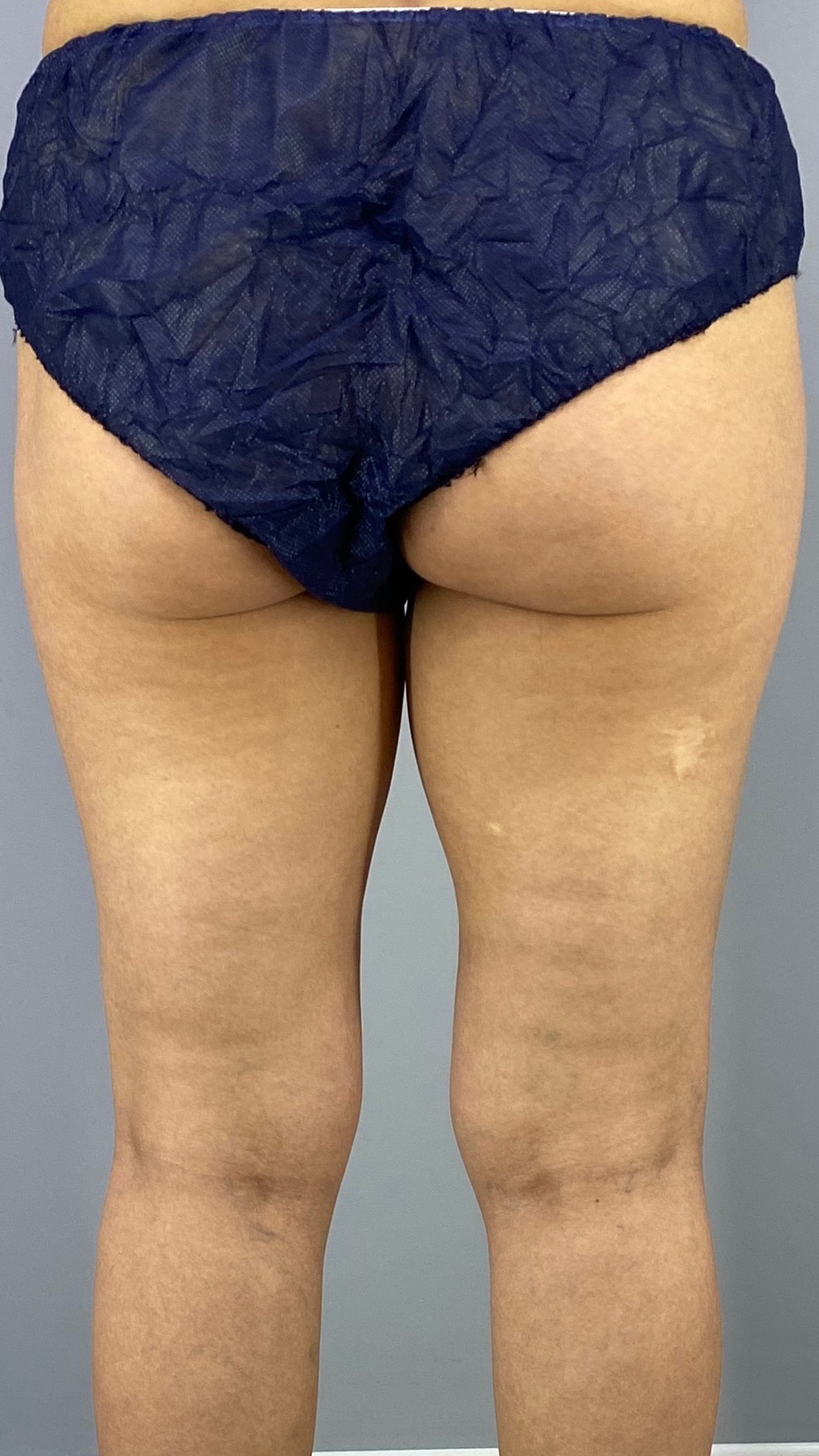 脂肪吸引日記 凄いコトに気付いてしまった 10年近く前に日本で太もも裏を脂肪吸引した際に残ってしまった 波打った様な セルライト跡が 無くなってるやないかーい トゥルンとしてるトゥルンと 細さに加え綺麗さを求める先生の腕に天晴れ
