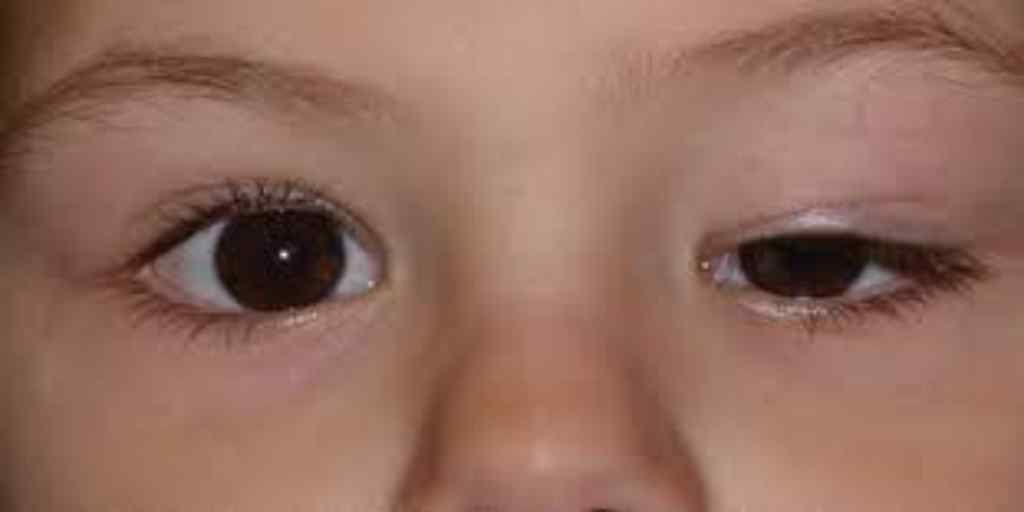connectrue's tweet image. Ptosis; how it affects child and adult connectrue.com/ptosis-how-it-…