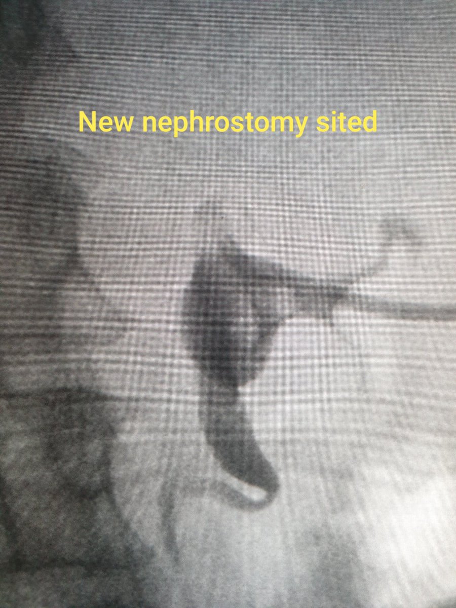 DrAidanShaw's tweet photo. Used this great technique for the first time yesterday with a completely blocked and encrusted nephrostomy that couldn't be re-wired. Actually thought of the post on table as it stuck out in my mind and it worked like a dream. Twitter is a great learning platform! #Irad https://t.co/LtGjmgJvbG