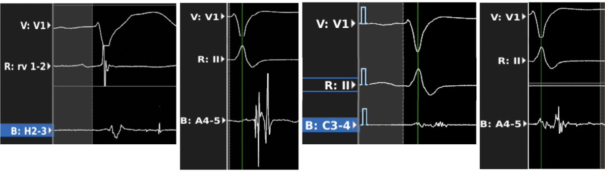 In the setting of #VT ablation, which of these three #LPs would you ablate? which one is bystander? In the 2020, with the excellent signal characteriz. provided by the multi electrode mapping cath, the #AI is behind the door. And are you ready? #predicting #innerloop during SR.