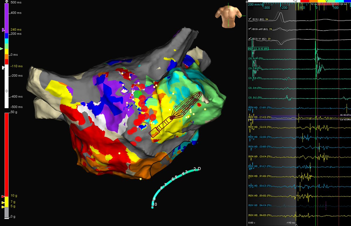 Jose Martel (@drjosemartel) on Twitter photo Left atrial flutter with CL 350 ms mapped with HD Grid. Terminated in one burn using Tacticath SE. No fluoro with < 5 min mapping.
#HDGrid #Epeeps #TacticathSE <a href="/AbbottCardio/">Abbott Cardiovascular</a> Left atrial flutter with CL 350 ms mapped with HD Grid. Terminated in one burn using Tacticath SE. No fluoro with < 5 min mapping.
#HDGrid #Epeeps #TacticathSE <a href="/AbbottCardio/">Abbott Cardiovascular</a>