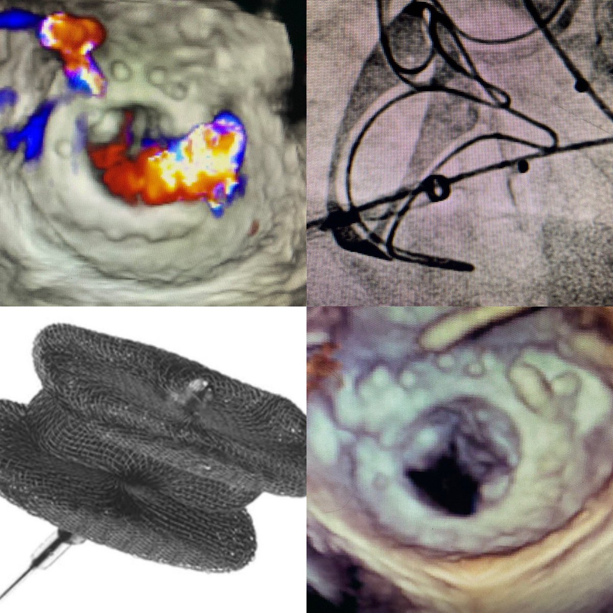 John T. Saxon, MD (@jtsaxon) on Twitter photo Monumental day for the #StructuralHeart program at <a href="/MidAmericaHeart/">Saint Luke's Mid America Heart Institute</a>: First implant of Amplatz Vascular Plug III in the United States! We treated 2 mitral PVL and 1 aortic PVL in a patient with limited options. Great result!
<a href="/akcmahi/">Adnan Chhatriwalla</a> <a href="/jtsaxon/">John T. Saxon, MD</a> <a href="/davidskolnick01/">David Skolnick MD</a> Monumental day for the #StructuralHeart program at <a href="/MidAmericaHeart/">Saint Luke's Mid America Heart Institute</a>: First implant of Amplatz Vascular Plug III in the United States! We treated 2 mitral PVL and 1 aortic PVL in a patient with limited options. Great result!
<a href="/akcmahi/">Adnan Chhatriwalla</a> <a href="/jtsaxon/">John T. Saxon, MD</a> <a href="/davidskolnick01/">David Skolnick MD</a>