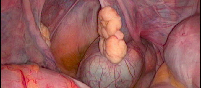 dukeobgyn's tweet photo. What type of mass is seen here, which is typically asymptomatic? Can you #DiagnoseThis from the latest #gynecology edition of @dukehealth #ClinicalPracticeToday? Click the link to test your knowledge. https://t.co/VgKHoRAcyI #medtwitter #meded https://t.co/2IQuCJJw7i