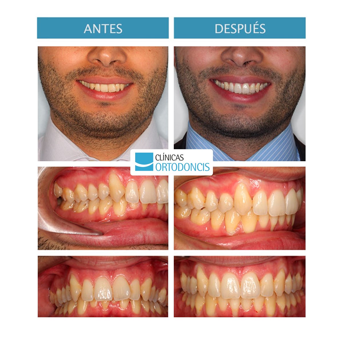 Con #ortodoncia invisible podemos conseguir unos excelentes resultados a cualquier edad y de la forma más cómoda posible.
