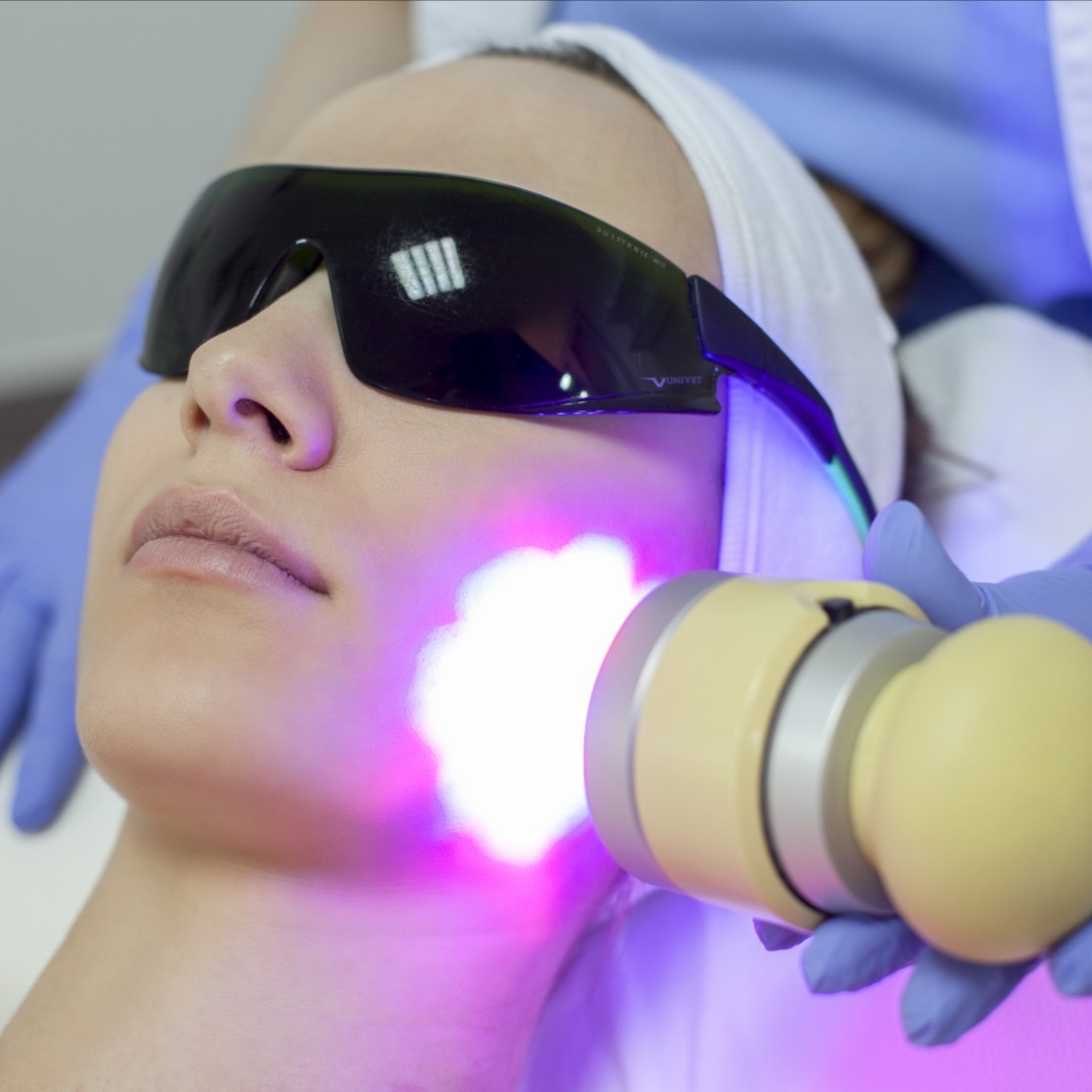 IPL treatments can be performed on face, neck, chest and hands, using pulses of visible light that effectively improve the appearance of brown spots and sun damage.