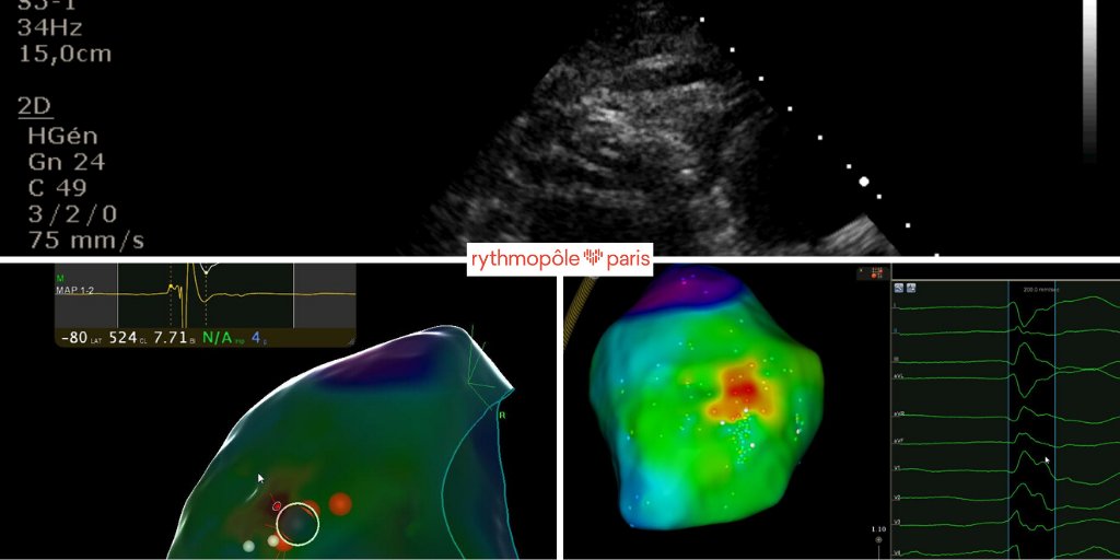 rythmopoleparis's tweet photo. 👩‍⚕️[How to avoid "dancing" catheters]👨‍⚕️

TTE guided anterolateral papillary muscle VT ablation.
Our incredible echo colleague Dr Christelle Diakov guided the transseptal puncture with peadiatric TOE &amp; monitored catheter stability [...]

#rythmopole #paris #VTablation #rythmology https://t.co/HfBW7uZAKC