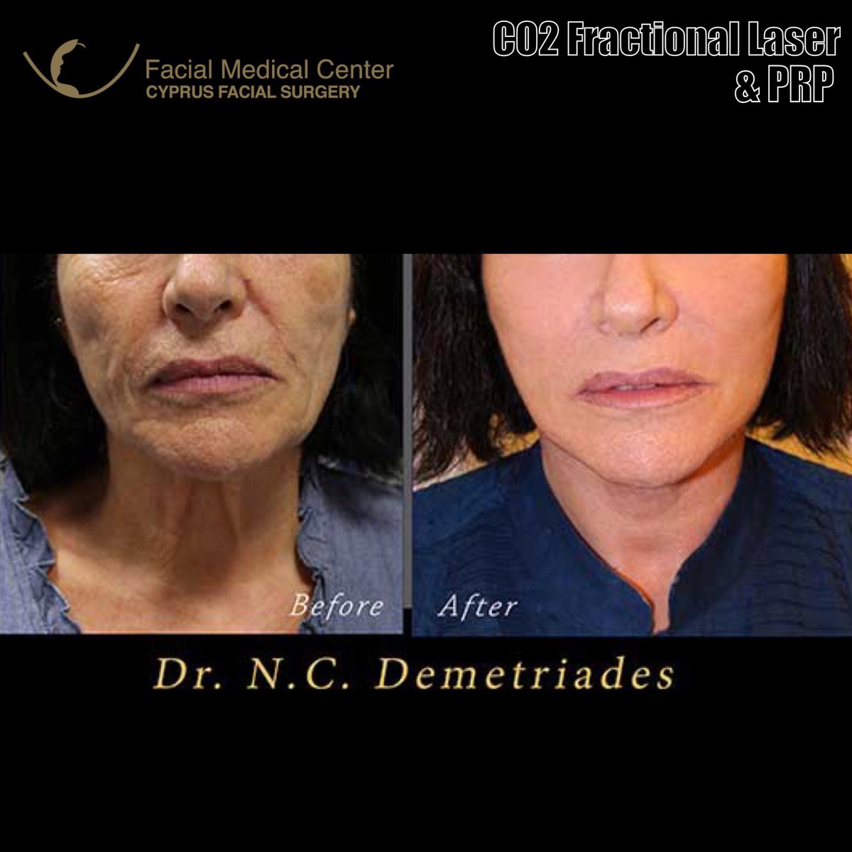DemetriadesNeo's tweet photo. ▪️CO2 Fractional Laser &amp; PRP
‼️BOOK your Laser treatment &amp; BE READY for the Summer ☀️ 
‼️NOW is the perfect TIME‼️
#co2laser #laserresurfacing #prp #facialrejuvenation
#nanofatgrafting #newstylelift #facelift #minimalinvasivefacelift
#rejuvenation #antiaging #co2fractional https://t.co/aE7ixR4ajU