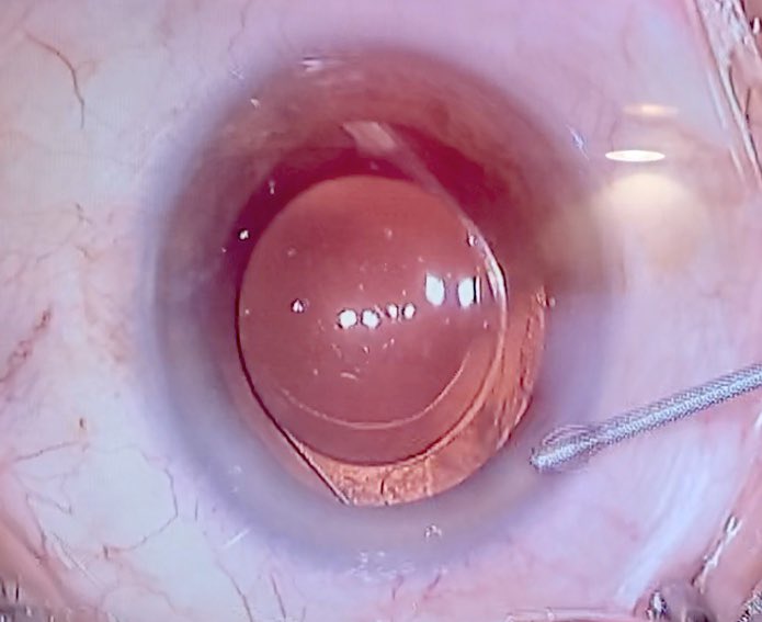 pablo_artal's tweet photo. Today I attended the cataract surgeries performed by Dr. José María Marin with our #ArtIOL @voptica intraocular lenses in @oftalvist Murcia
Hospital La Vega @GrupoHLA
So happy to see our unique optical technology helping patients to see better! https://t.co/8lisLiMUnO