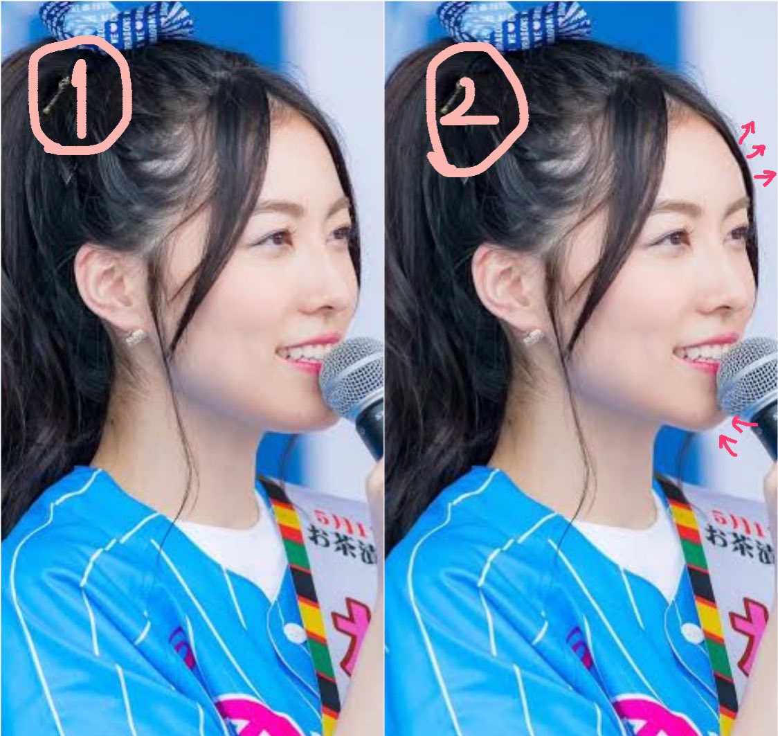 額ヒアルロン酸