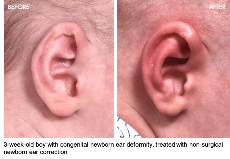 AvivaPSA's tweet photo. We are thrilled with the treatment outcome of our latest young #Earwell patient! This 3-week-old boy was brought in by his parents for concerns of misshapen ears, and Dr. Fishman treated him with non-surgical and painless splinting or reshaping of the #ears.

#ear #newborn https://t.co/LEIPbE3956