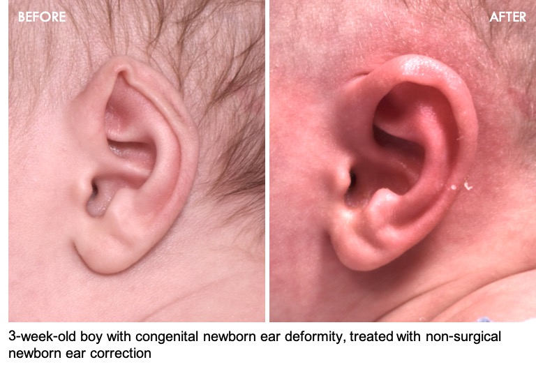 AvivaPSA's tweet photo. We are thrilled with the treatment outcome of our latest young #Earwell patient! This 3-week-old boy was brought in by his parents for concerns of misshapen ears, and Dr. Fishman treated him with non-surgical and painless splinting or reshaping of the #ears.

#ear #newborn https://t.co/LEIPbE3956